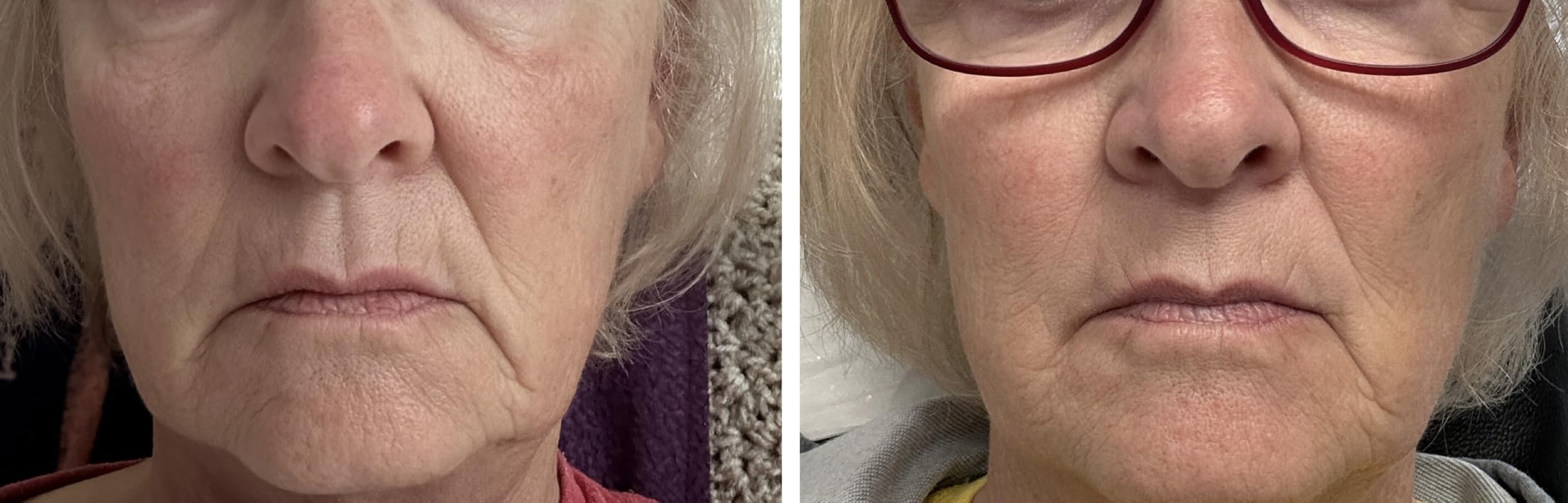 1450nm Laser Facial Beauty Device for Collagen Stimulation, Anti-Aging, Skin Tightening & Radiance, Wrinkle Reduction, Fading Acne Scars, and Pore Tightening customer photo 1